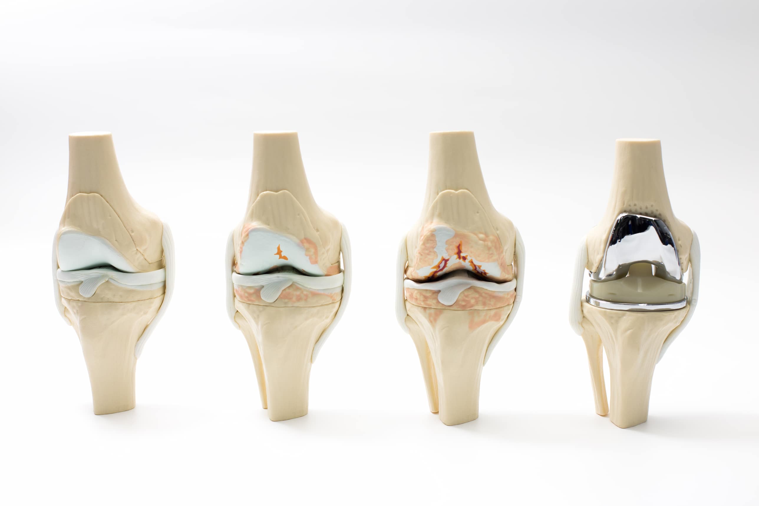 Turkiye knee replacement surgery procedure