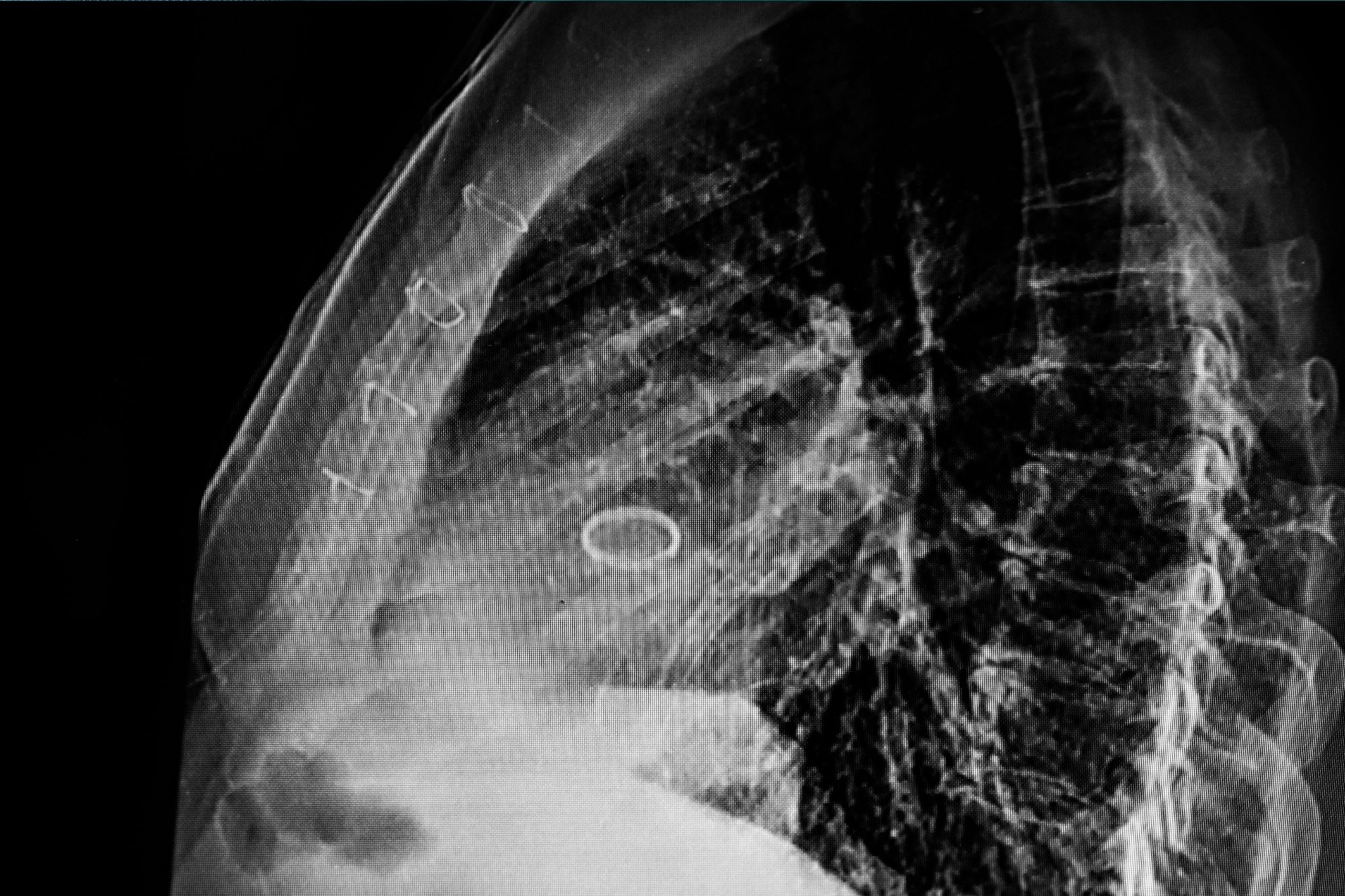 Remplacement de la valve aortique par voie transcathétérale en turquie