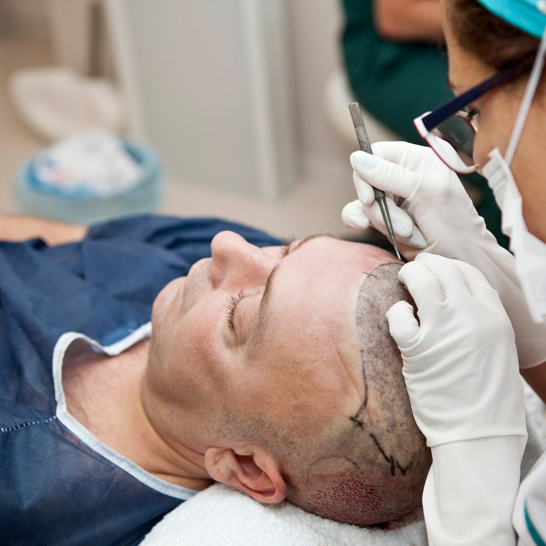 How does DHI Pro Hair Transplant differ from traditional methods in Turkey?