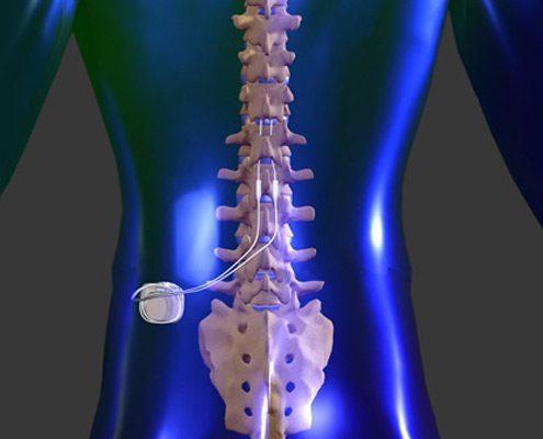 spinal cord stimulator for cancer pain