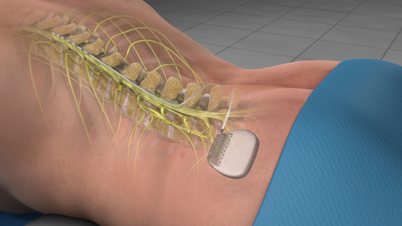 Spinal Cord Stimulation Removal