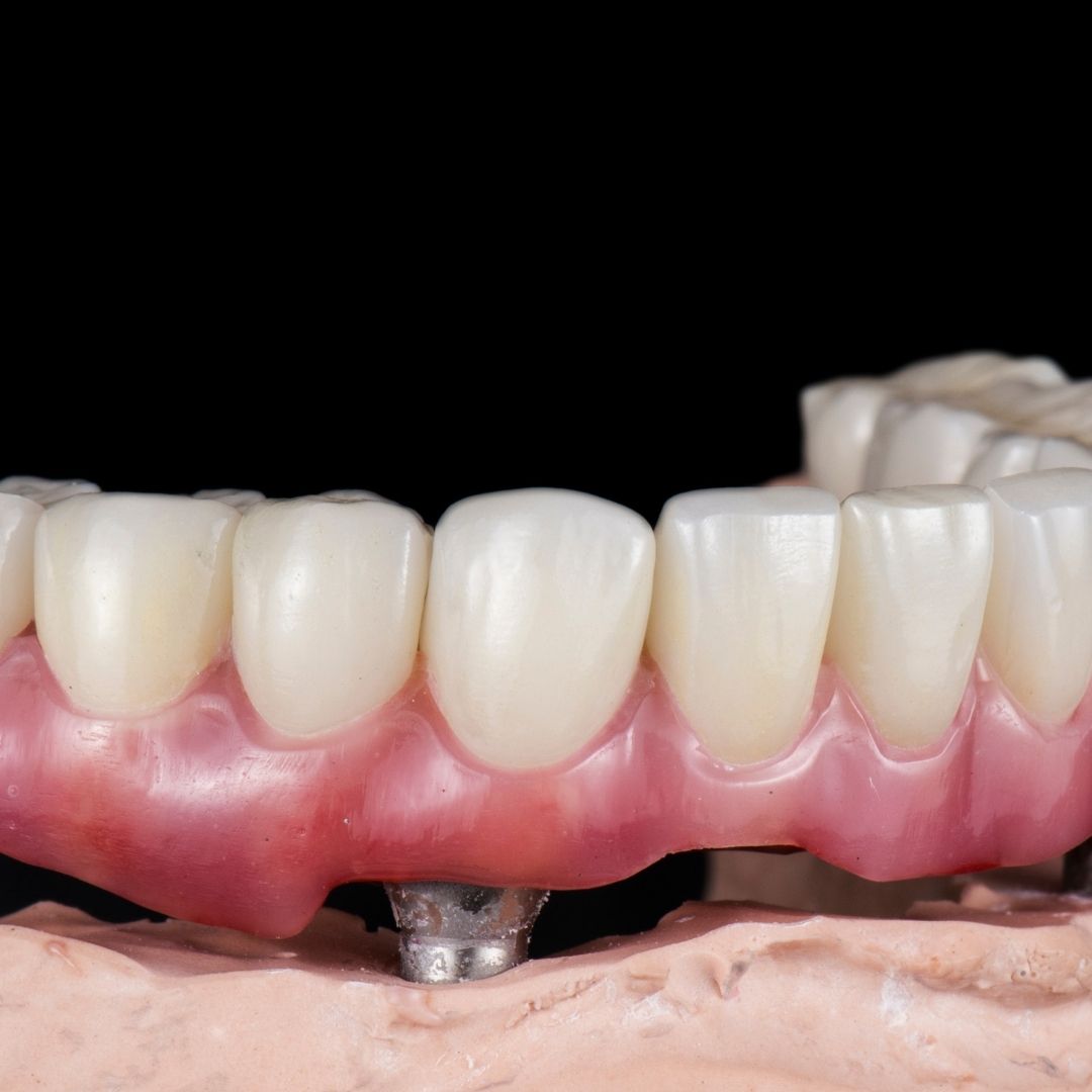 all on 6 dental implants results in turkey