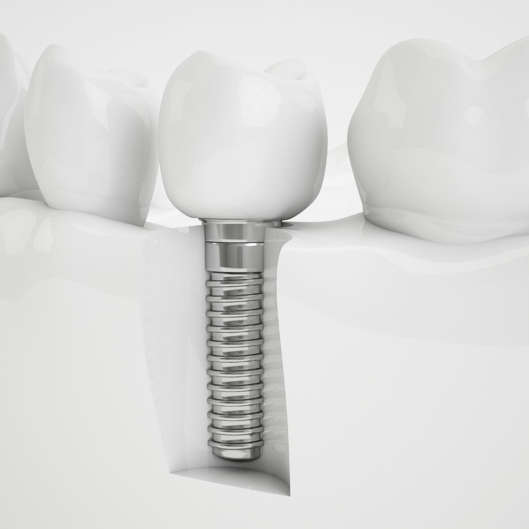 Dental Implant Results in Turkey