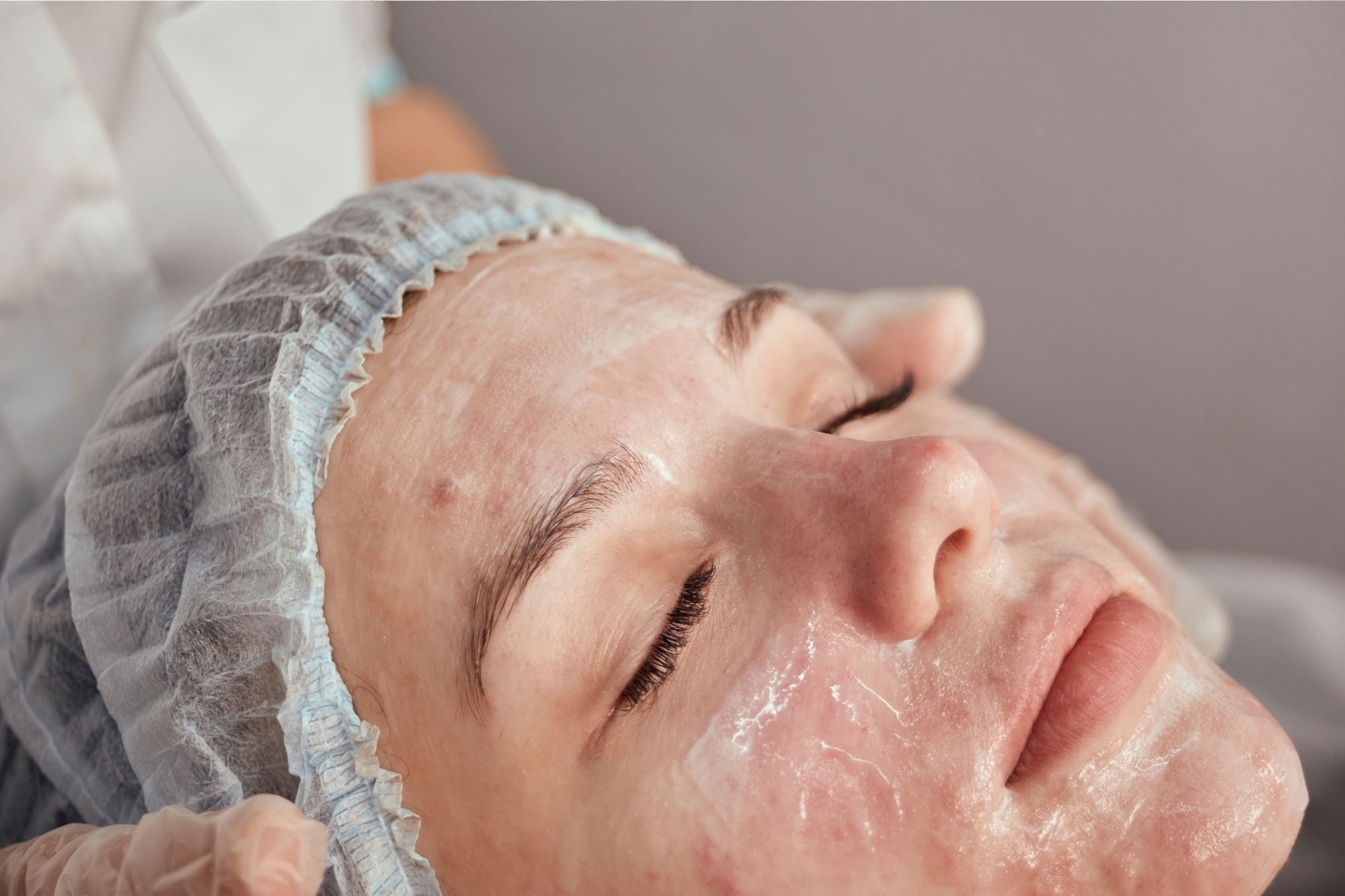 Acne treatment turkiye