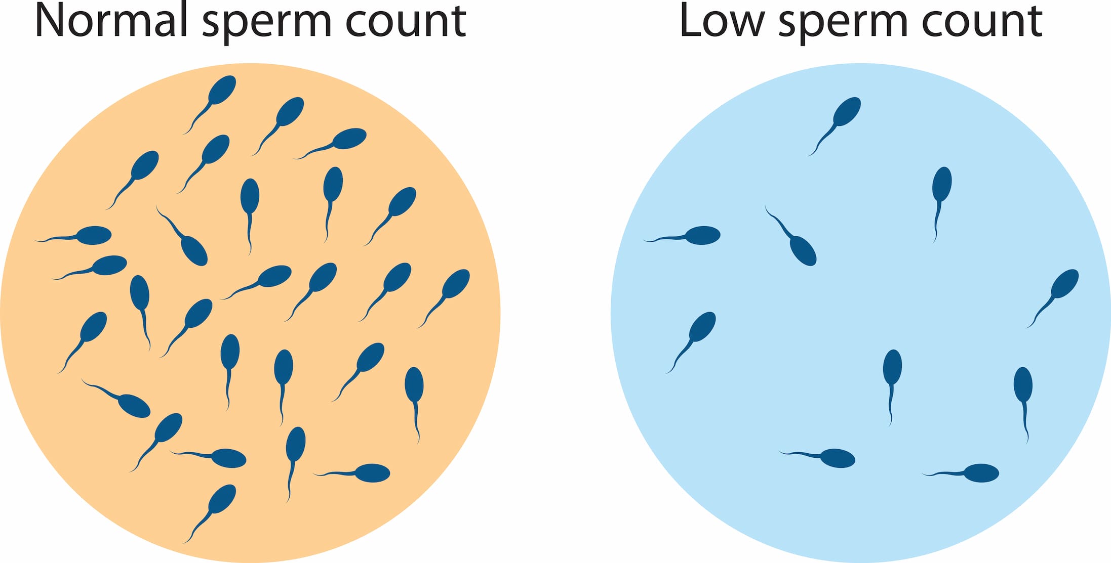 Low sperm count treatment in turkiye