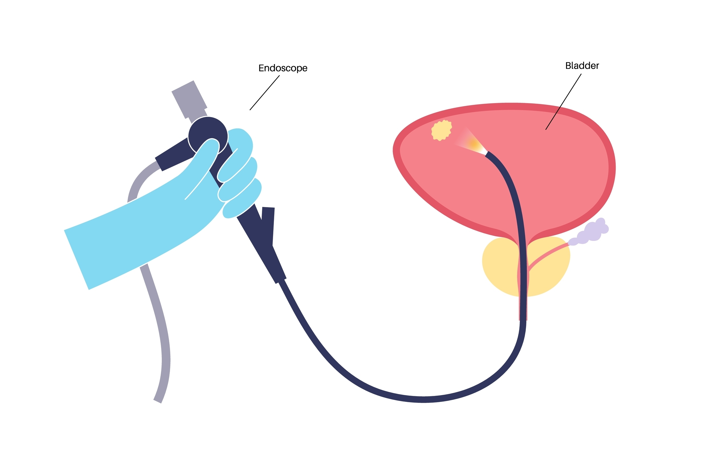 Cystoscopy in turkey