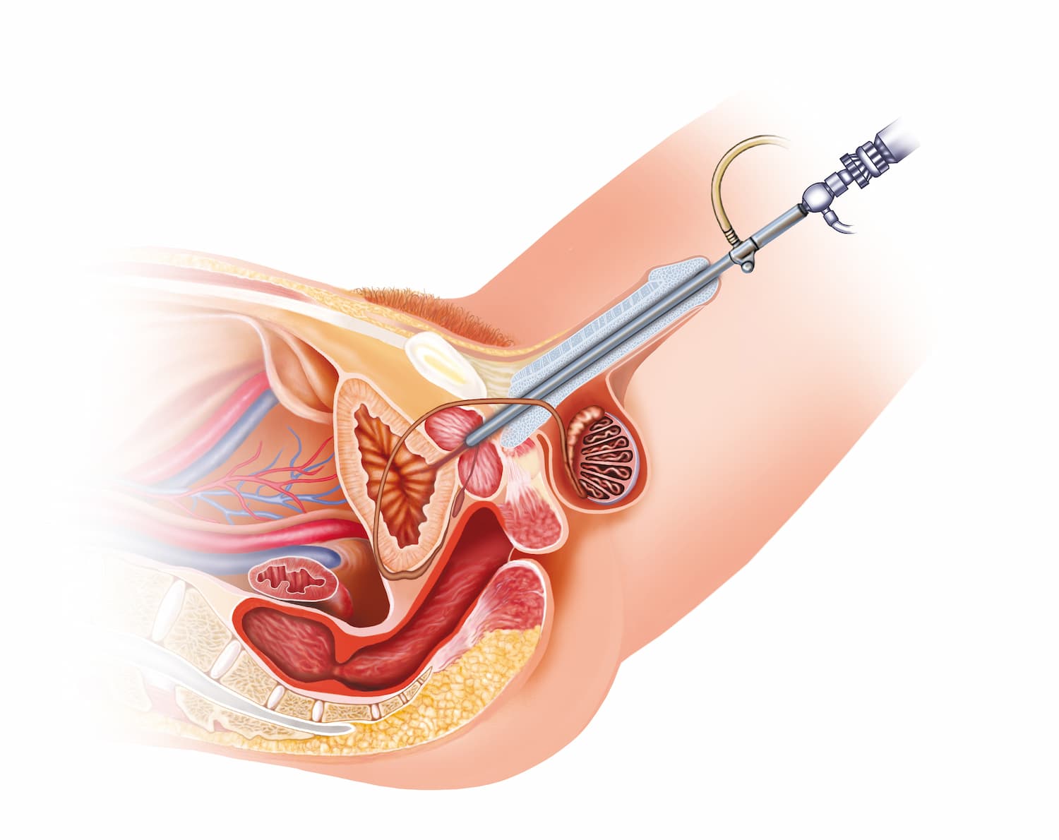 Cystoscopy in turkiye