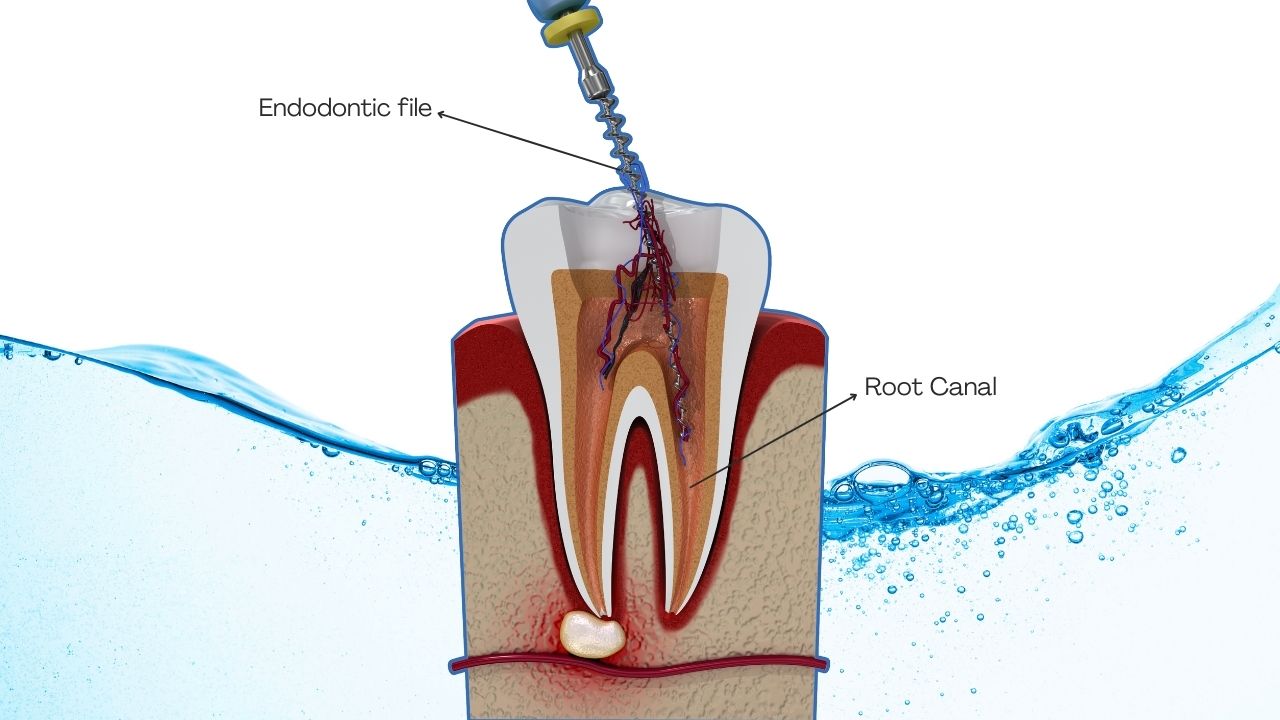 Root canal treatment in turkey