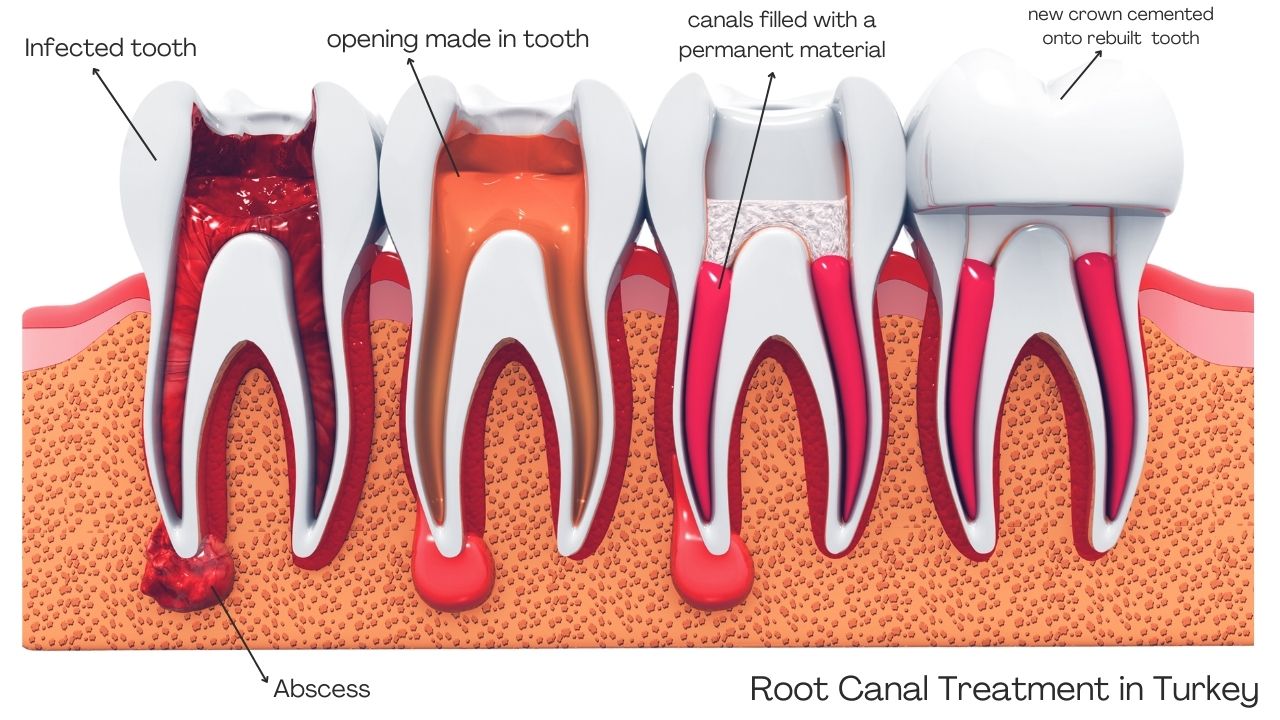 Root canal turkey