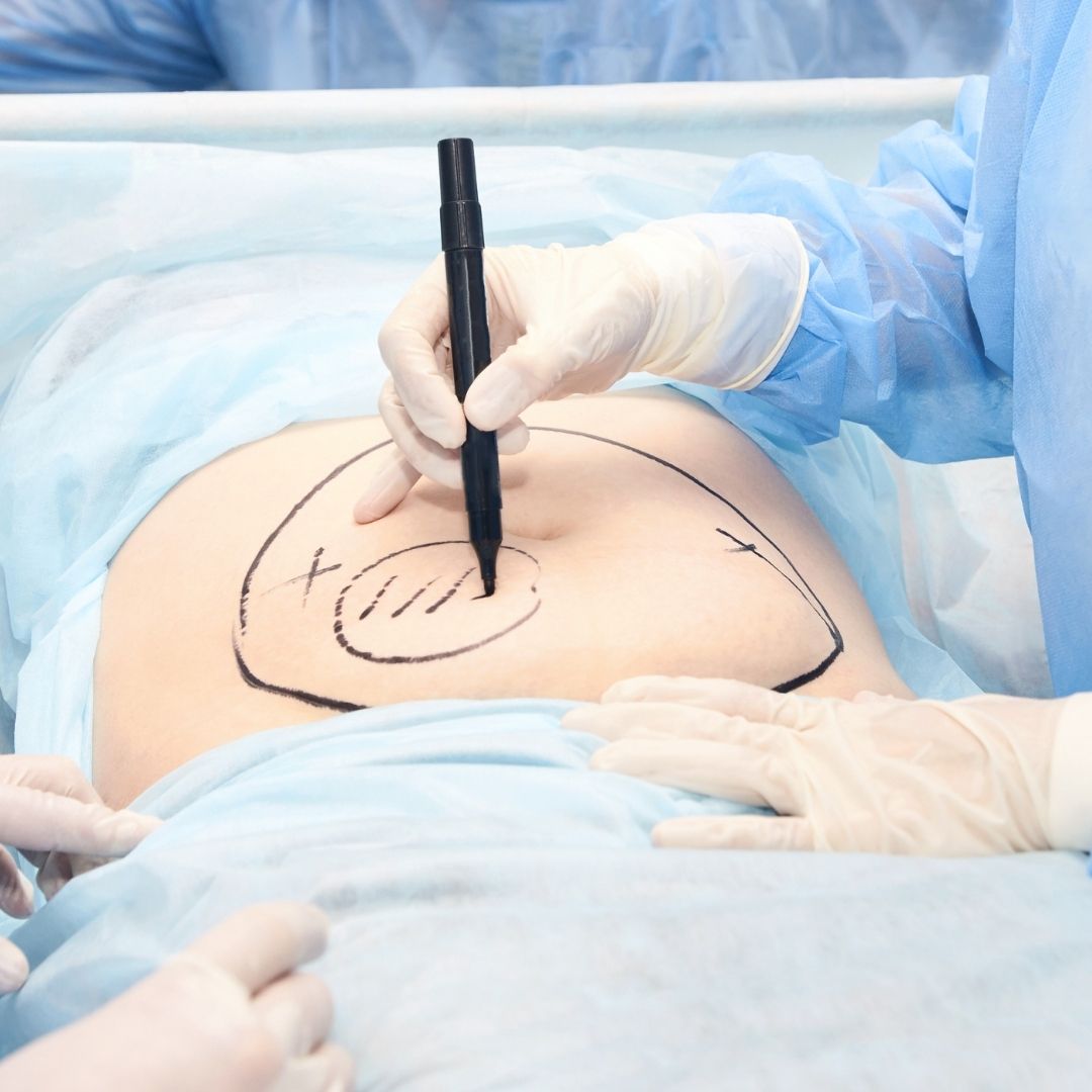 Liposuction Surgeons in Turkey