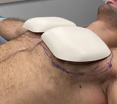 best clinics for pectoral implants in turkey