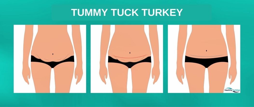 Turkey tummy tuck