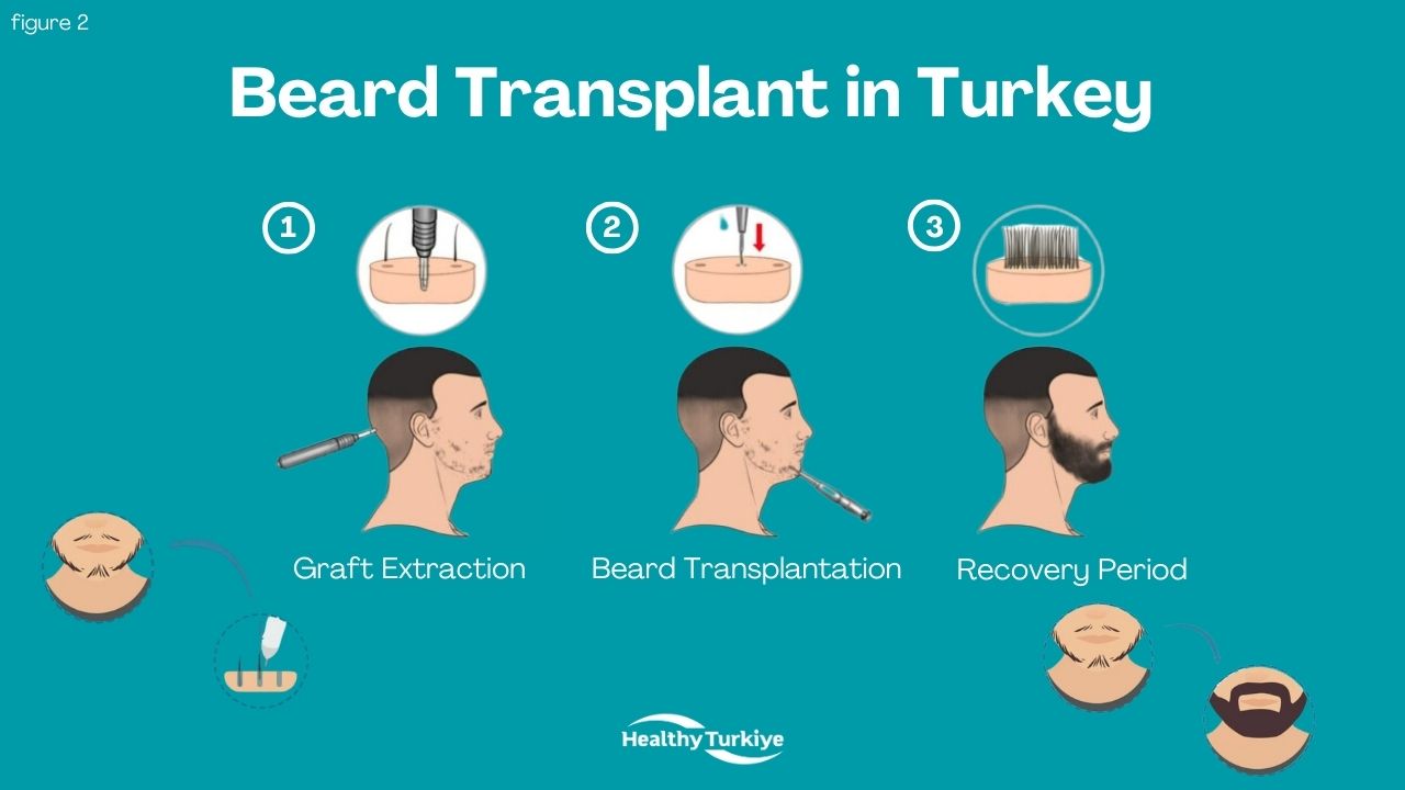 Turkey beard transplant