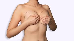 Cost of Breast Lift in Turkey
