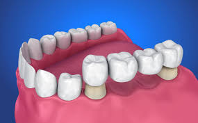 Best Clinics for Dental Bridge in Turkey