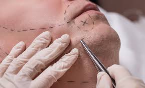 beard transplant surgeons in turkey