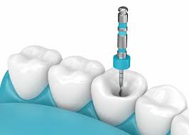 Cost of Root Canal Treatment in Turkey