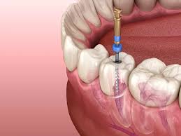 best clinics for root canal treatment in turkey