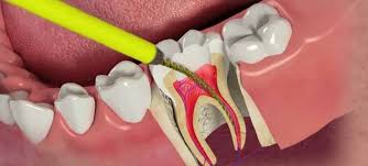 Root Canal Treatment Surgeons in Turkey