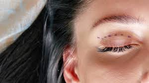Eye Surgery Results in Turkey