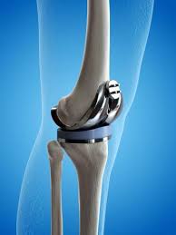 Cost of Knee Replacement Surgery in Turkey