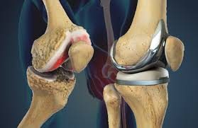 Knee Replacement Surgery Results in Turkey
