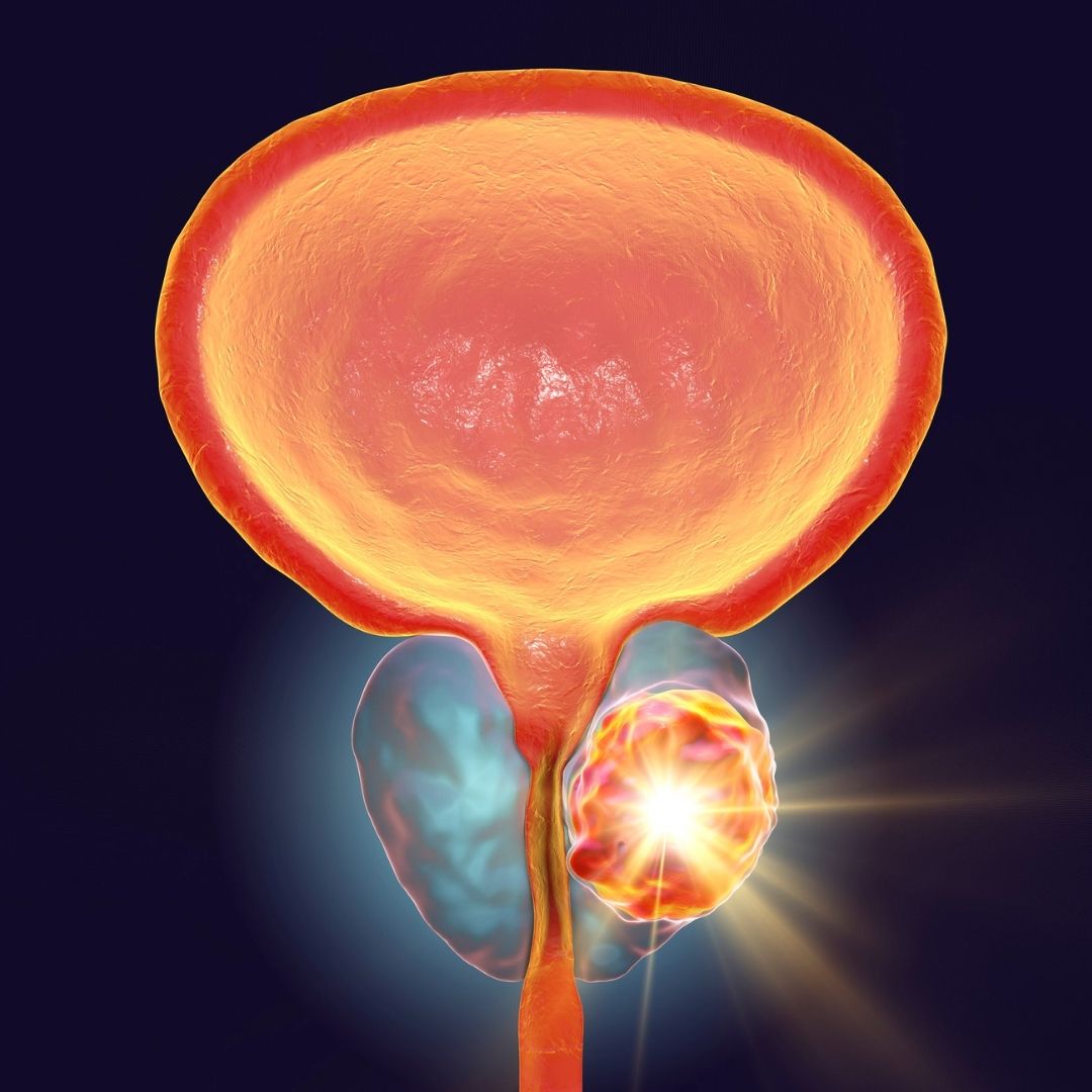 Cost of Prostatectomy Treatment in Turkey