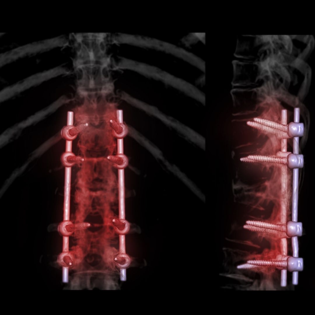 aftercare for spinal surgery in turkey