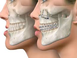 Cost of Jaw Surgery in Turkey