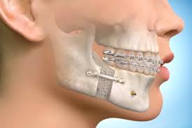 best clinics for jaw surgery in turkey