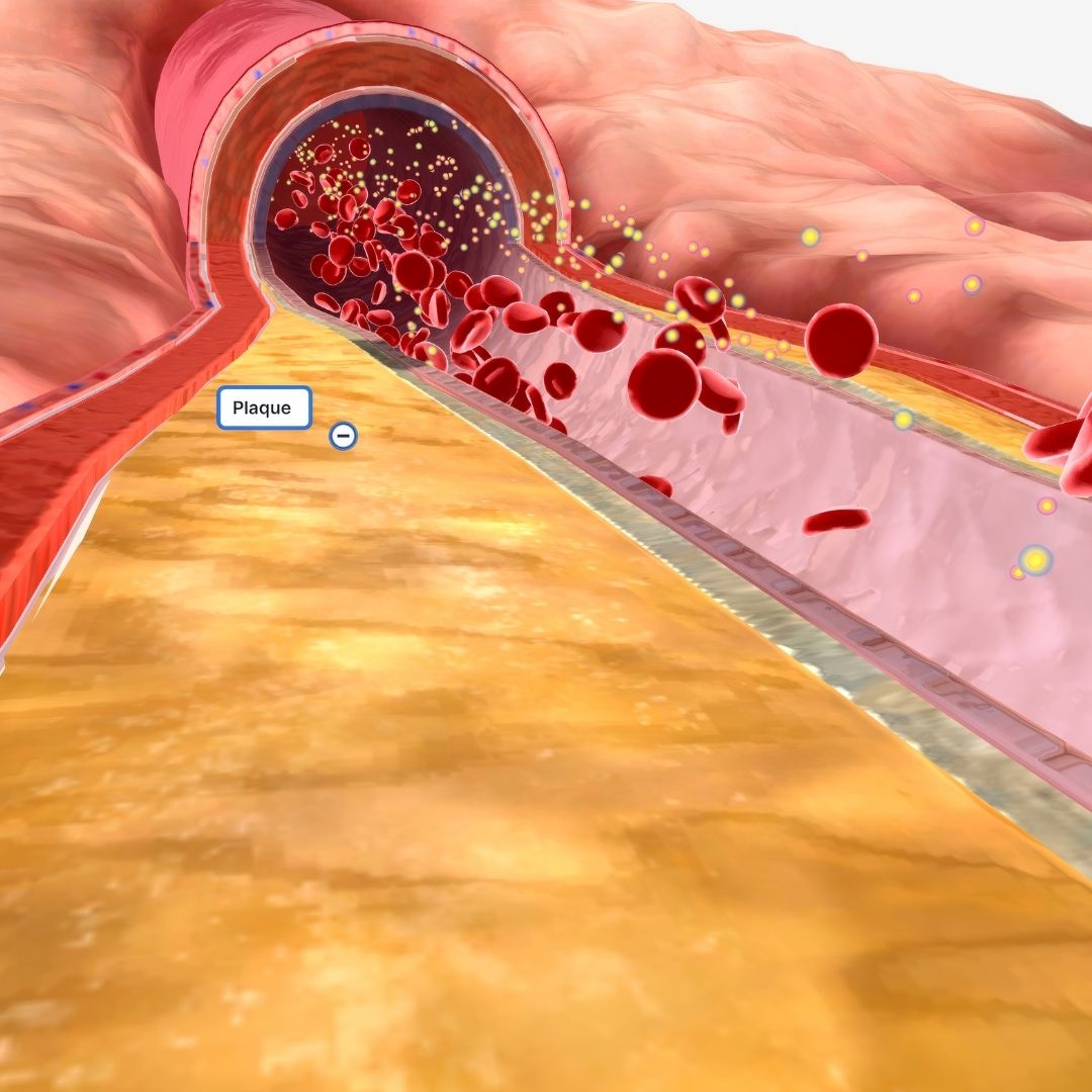 Peripheral Artery Disease Treatment Results in Turkey