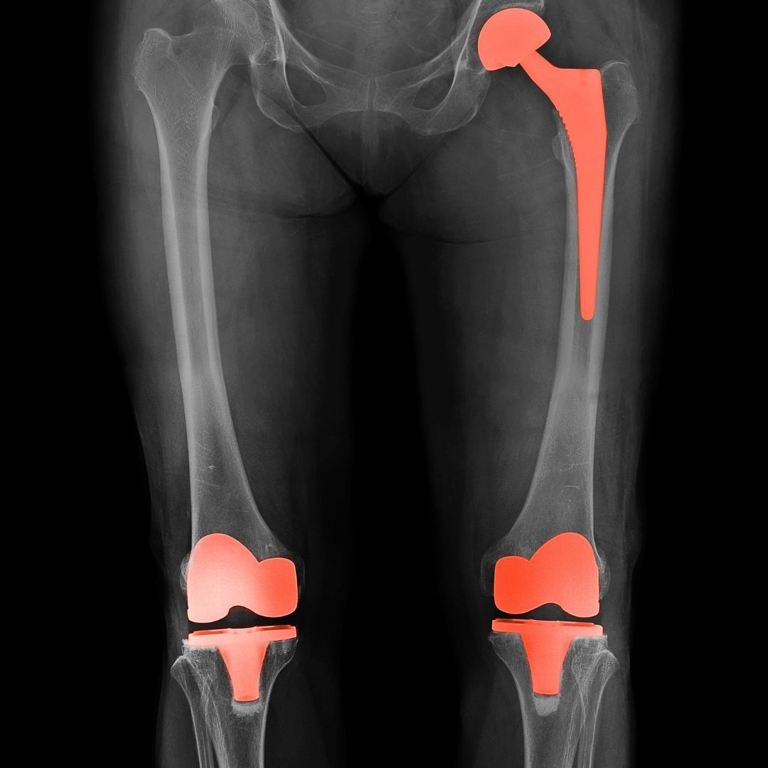 aftercare for hip replacement surgery in turkey