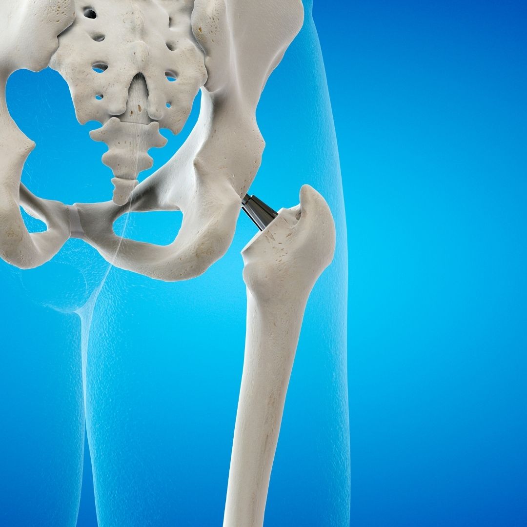 hip replacement surgery surgeons in turkey