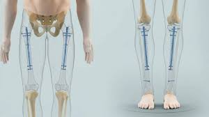 Cost of Limb Lengthening Surgery in Turkey