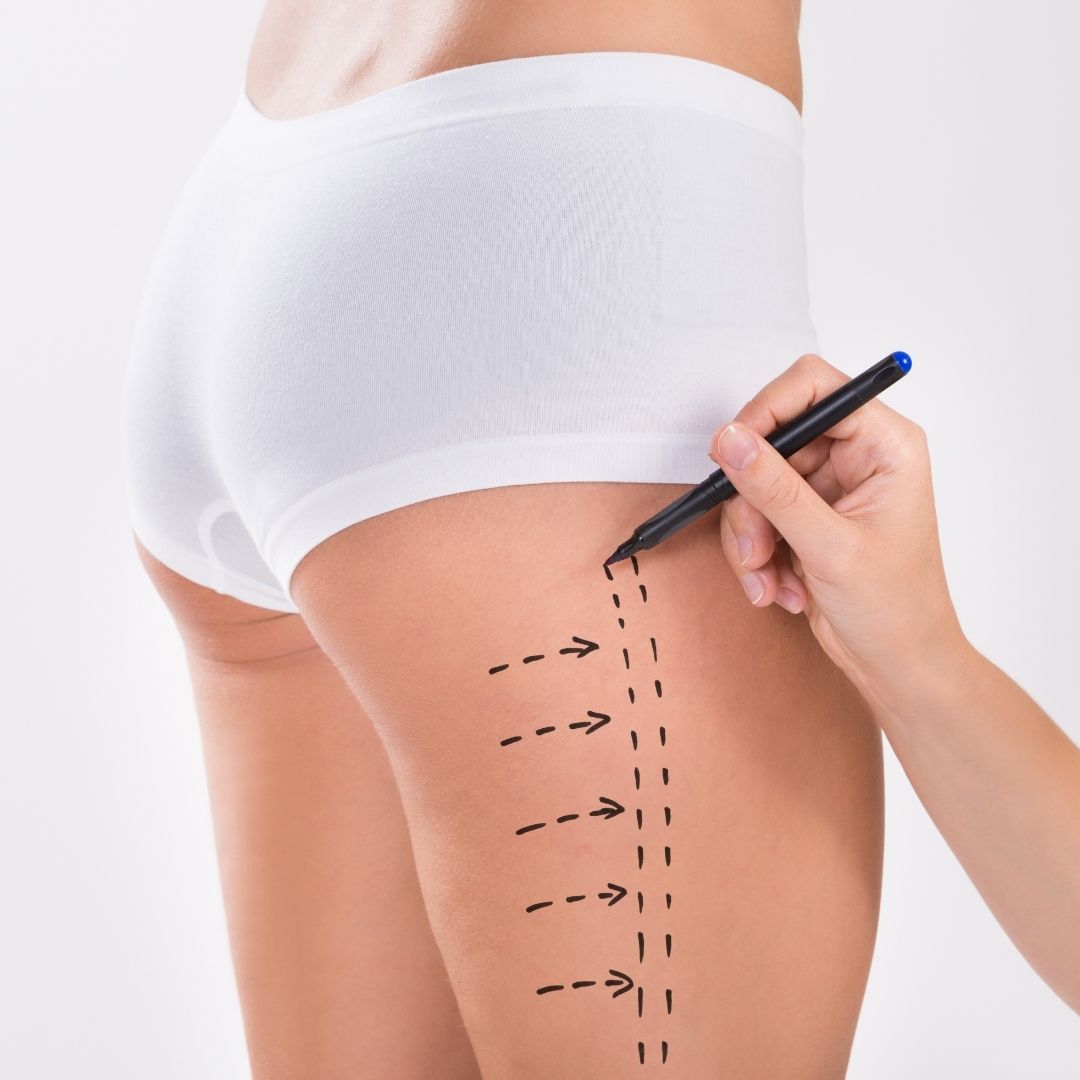 Thigh Lift Surgery Surgeons in Turkey