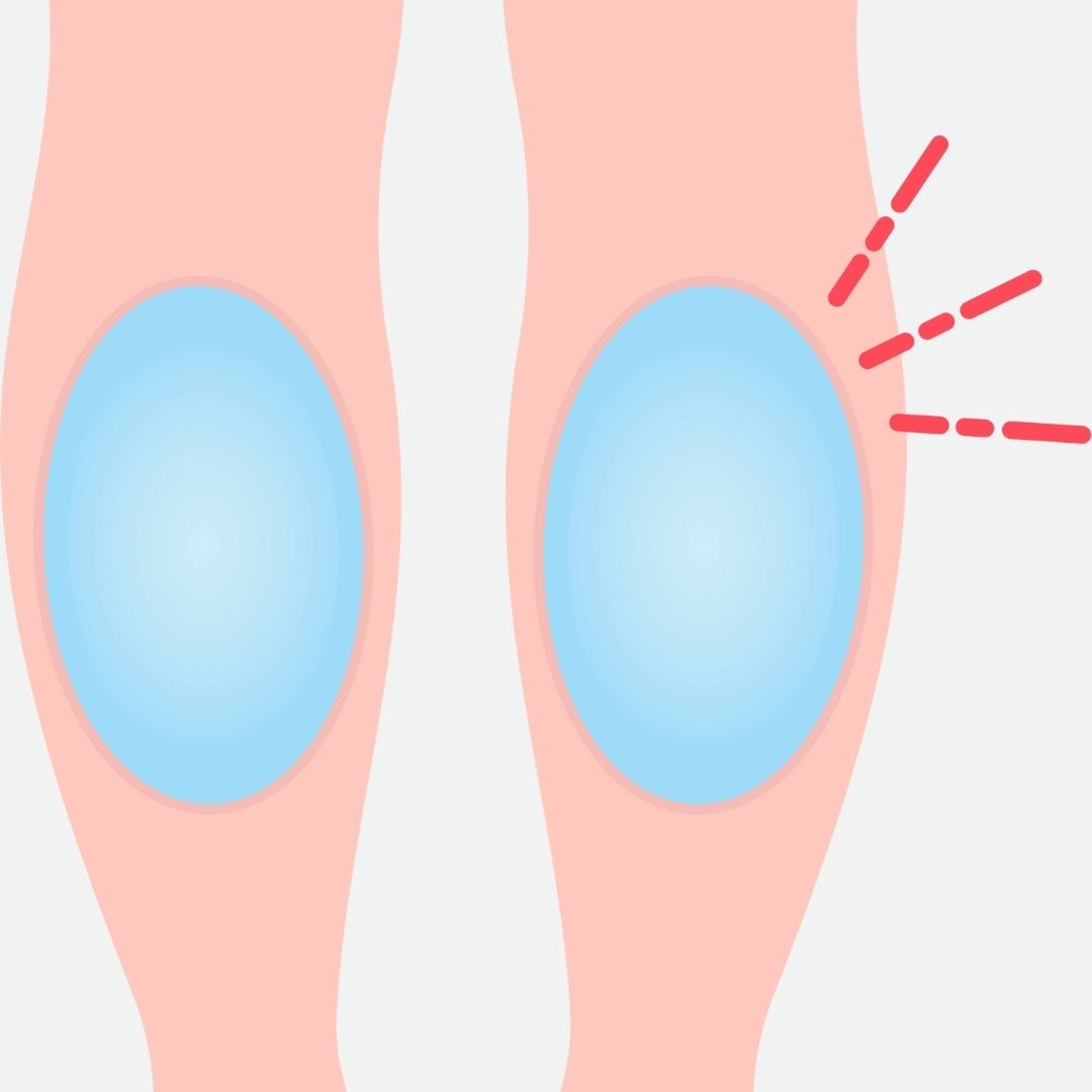 cost of calf implant in turkey