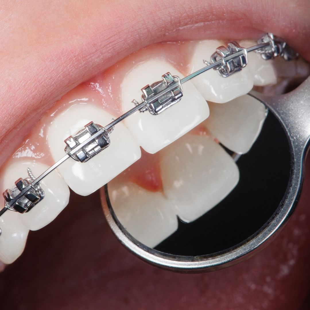 Cost of Dental Braces Treatment in Turkey