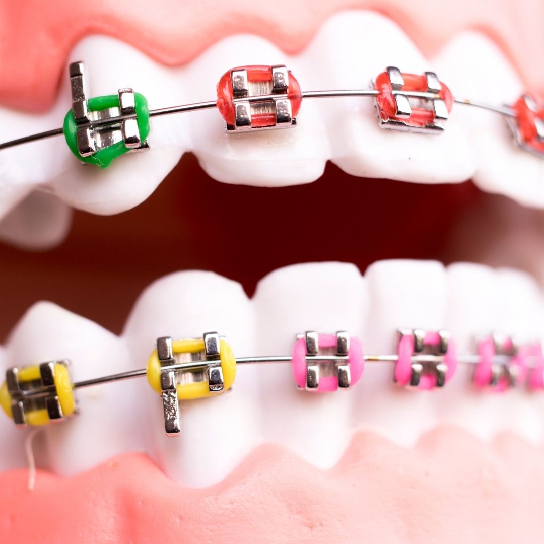 Dental Braces Treatment Results in Turkey