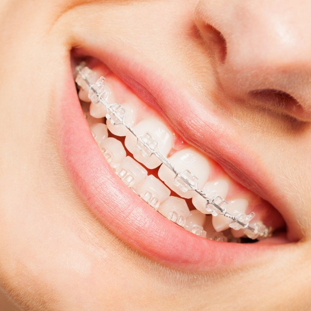 Aftercare for Dental Braces Treatment in Turkey