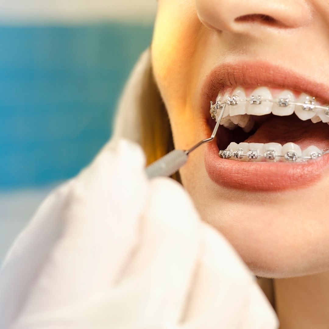 dental braces treatment surgeons in turkey