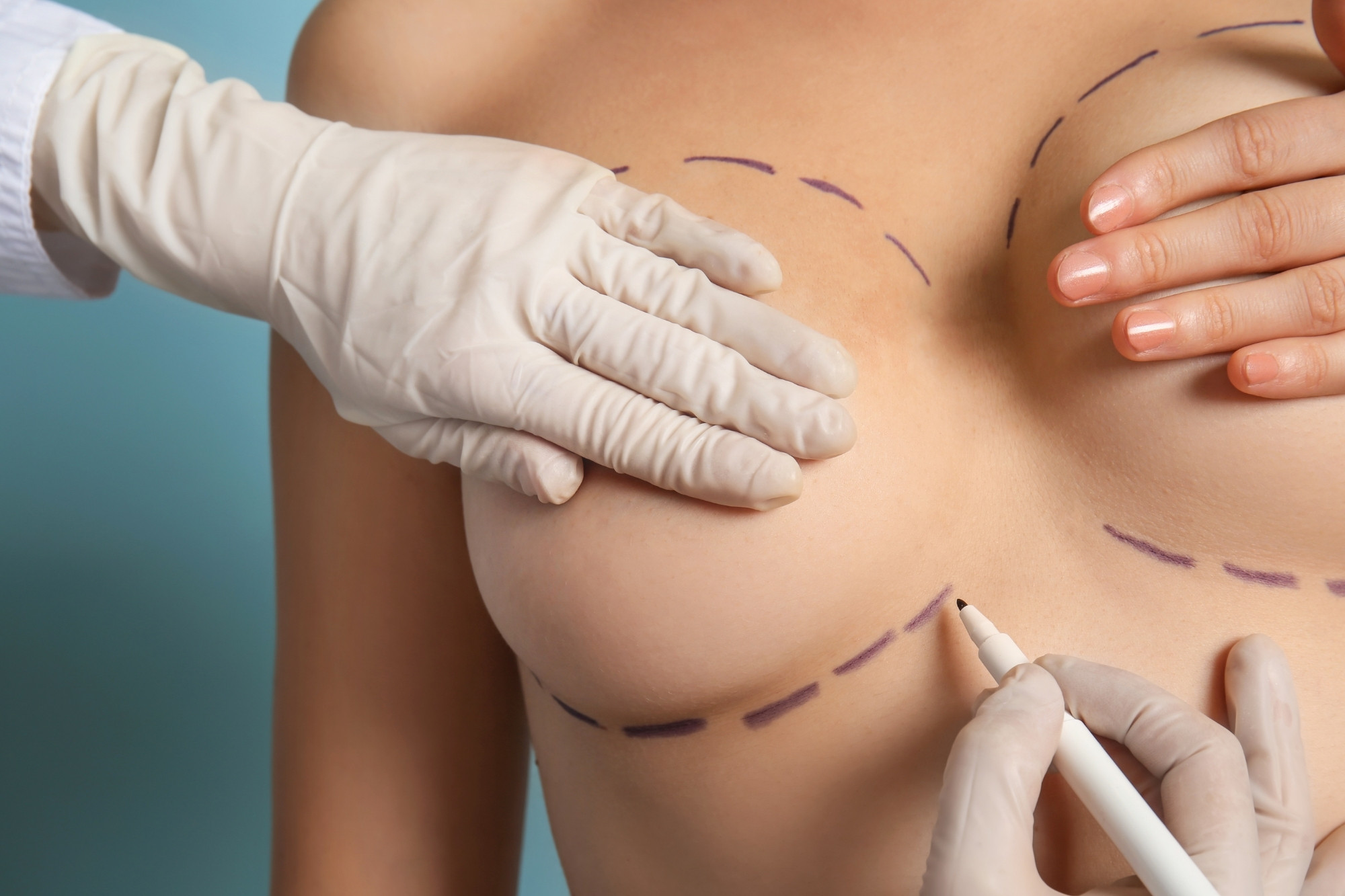 Everything You Need to Know About 800cc Breast Implants