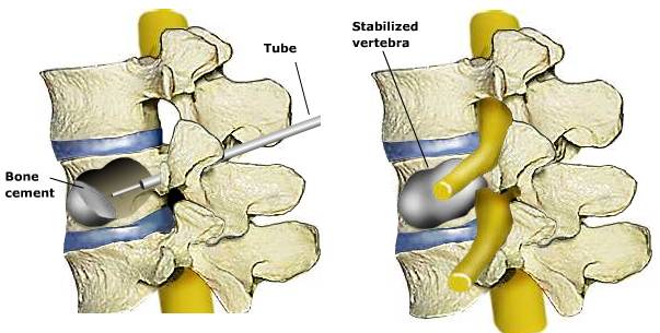 Kyphoplasty turkiye