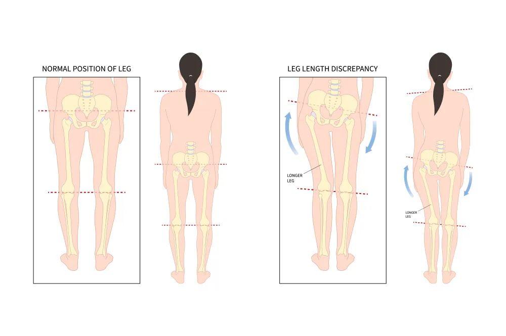 Limb length discrepancy in childrenjpeg