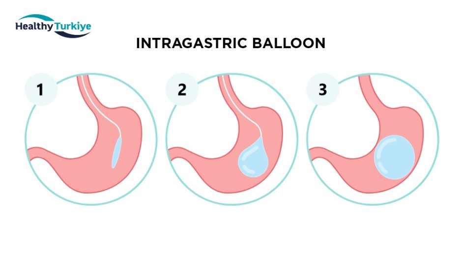 Turkiye bariatric surgery