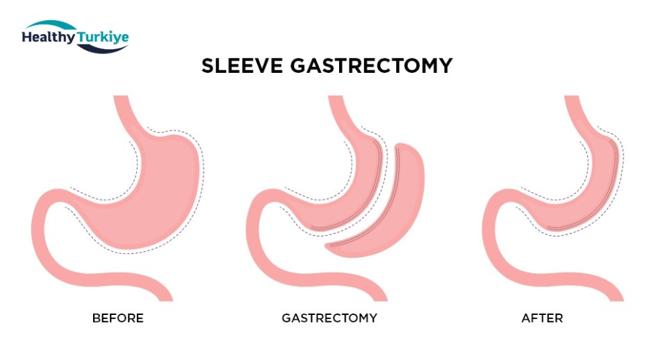 Bariatric surgery procedure turkey