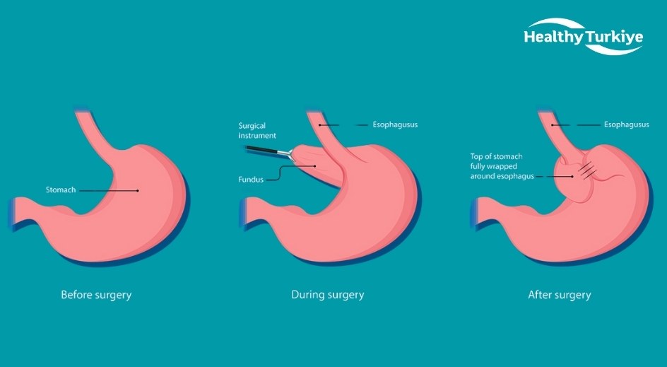 Nissen fundoplication surgery in turkiye