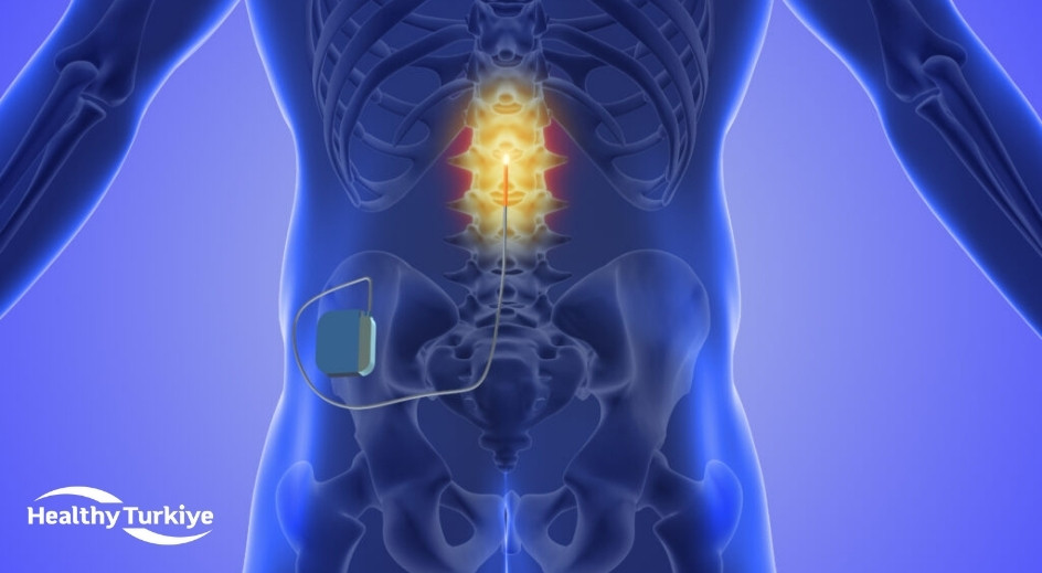 Spinal cord stimulation turkey