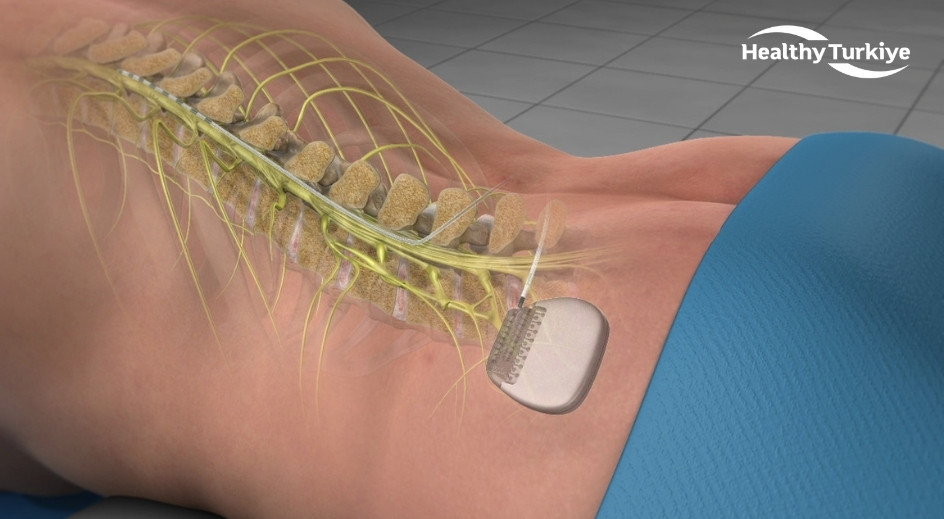 Spinal cord stimulation in turkey