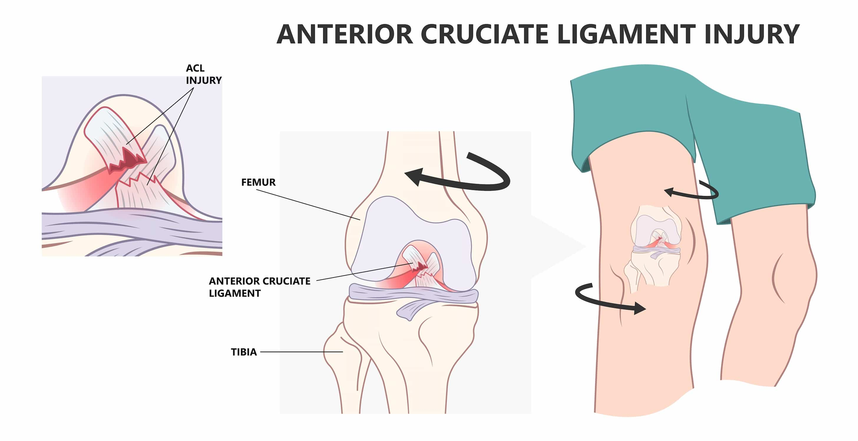 Acl reconstruction surgery turkey