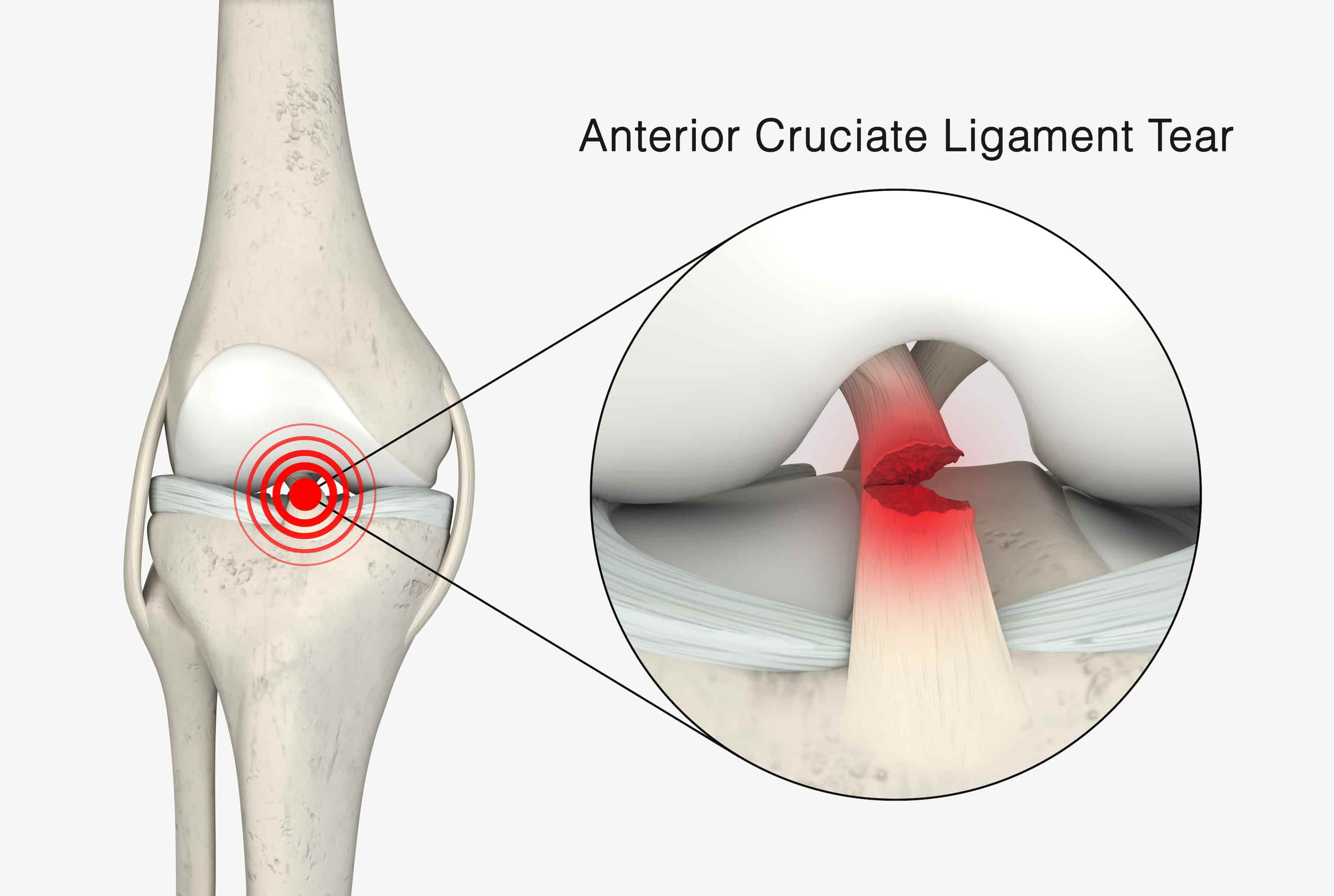 Acl surgery in turkey